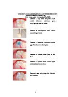 Tahapan Aplikasi Fissure Sealant Berbasis Semen Ionomer Kaca